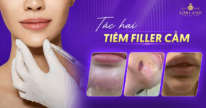 Tác hại của tiêm filler cằm