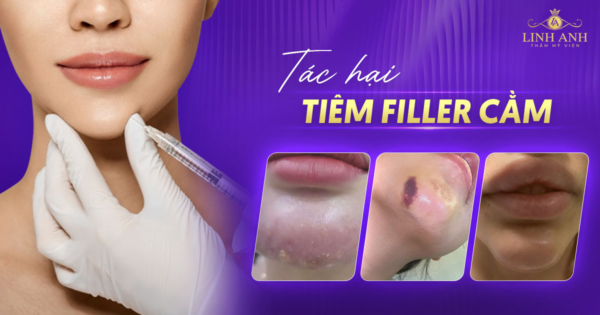 Tác hại tiêm filler cằm: Chuyên gia cảnh báo những rủi ro tiềm ẩn