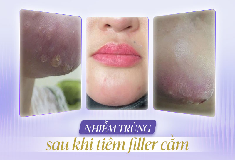 Tác hại của việc tiêm filler cằm