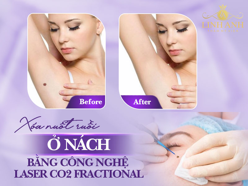Tẩy nốt ruồi ở nách bằng công nghệ Laser Fractional CO2