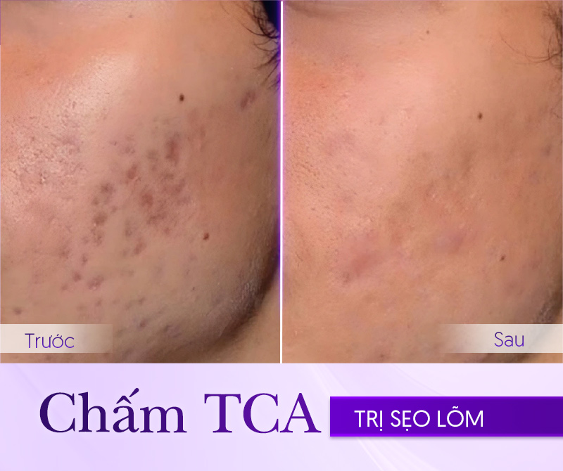 TCA chấm sẹo rỗ