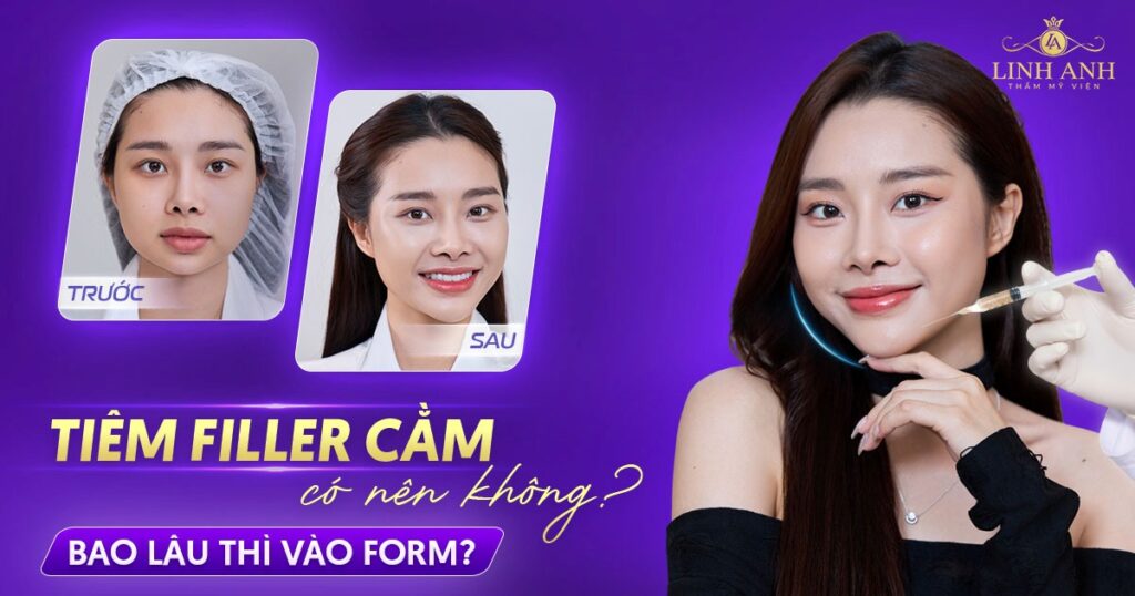Tiêm filler cằm