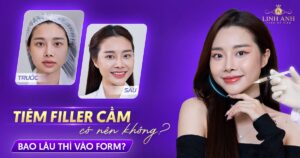 Tiêm filler cằm