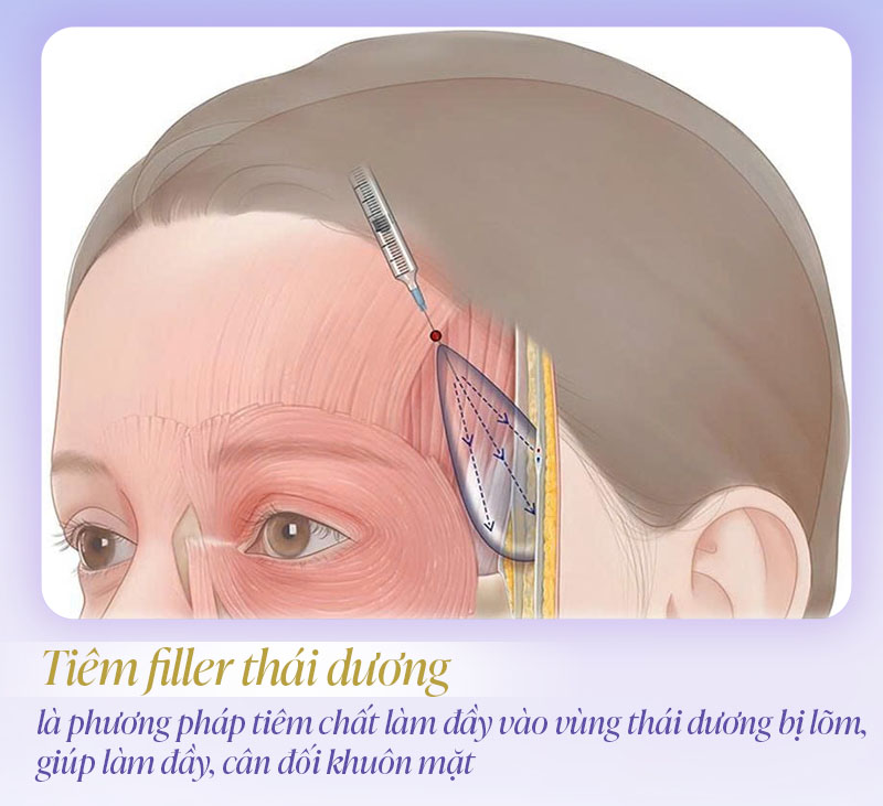 Tiêm đầy thái dương