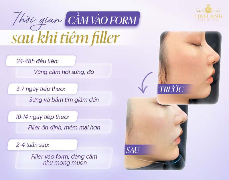 Tiêm filler cằm bao lâu thì vào form