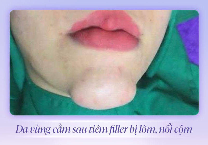 Tiêm filler cằm bị vón cục