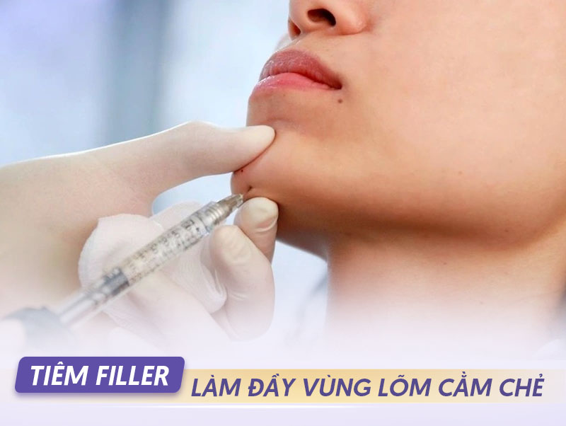 Tiêm filler cằm chẻ