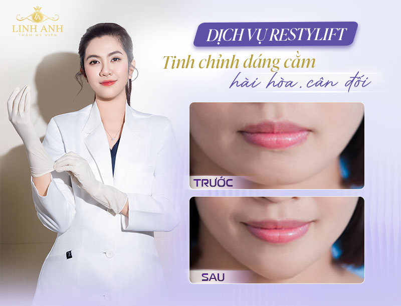 Tiêm filler chỉnh cằm hài hòa, cân đối