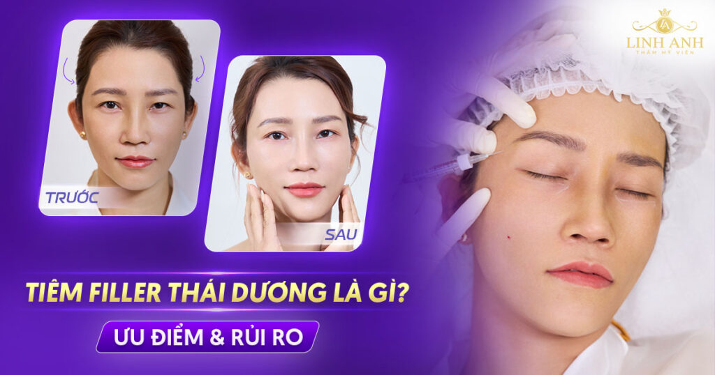 Tiêm filler thái dương