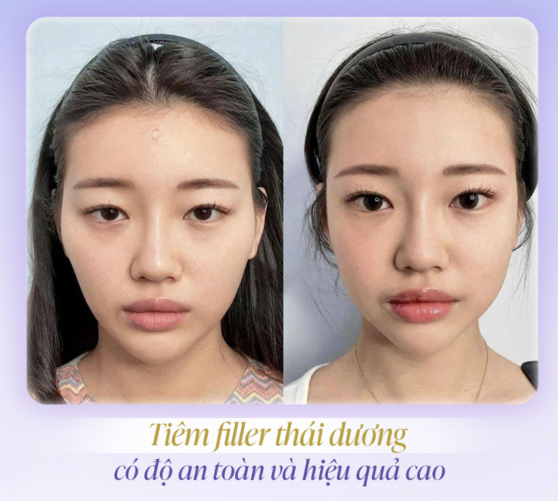 Tiêm đầy thái dương