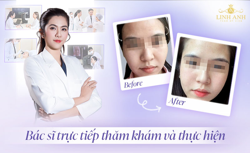 Tiêm filler thái dương ở đâu