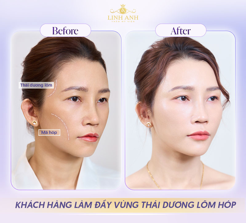 Tiêm Filler Vùng Thái Dương
