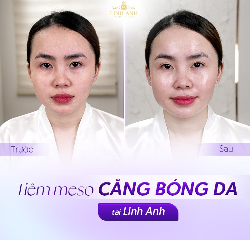 Tiêm Meso có tốt không