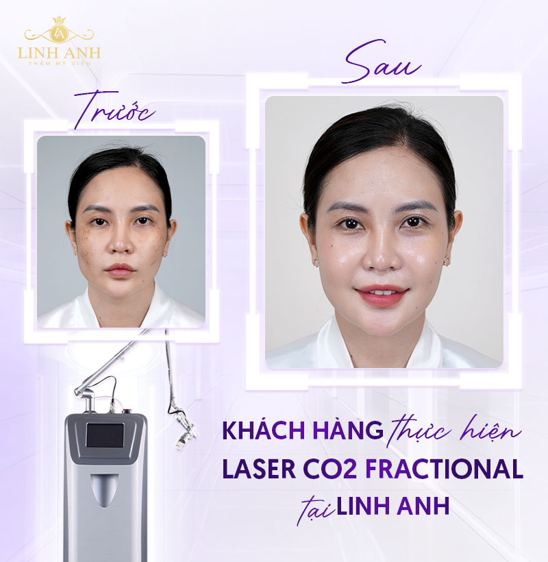 trẻ hóa da bằng Laser CO2 Fractional