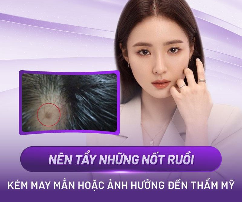 trên đầu có nốt ruồi trên đầu có nốt ruồi
