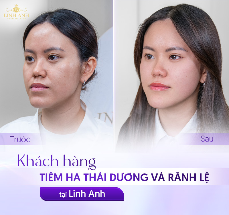 ứng dung của tiêm HA