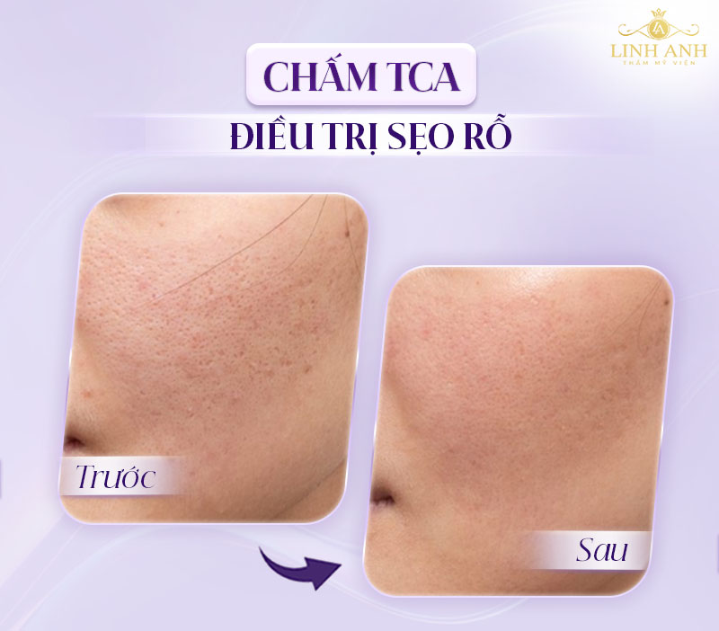 vai trò của TCA trong điều trị da