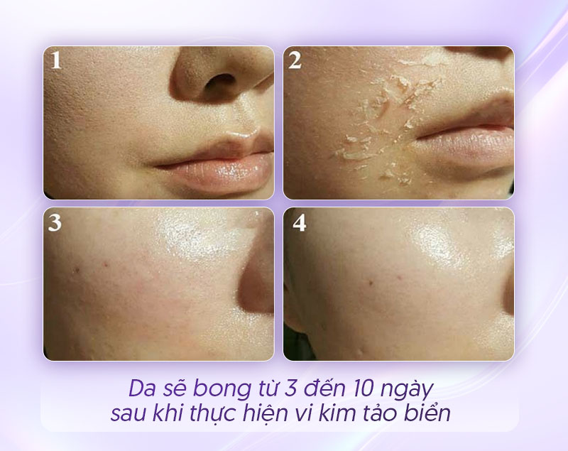 Vi kim tảo biển bao lâu thì da bong