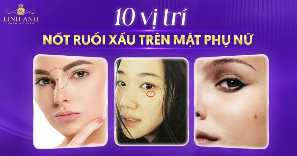 vị trí nốt ruồi xấu trên mặt phụ nữ