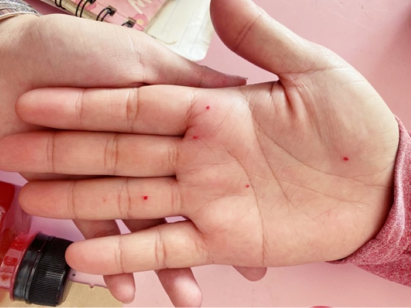 Xem nốt ruồi trong lòng bàn tay