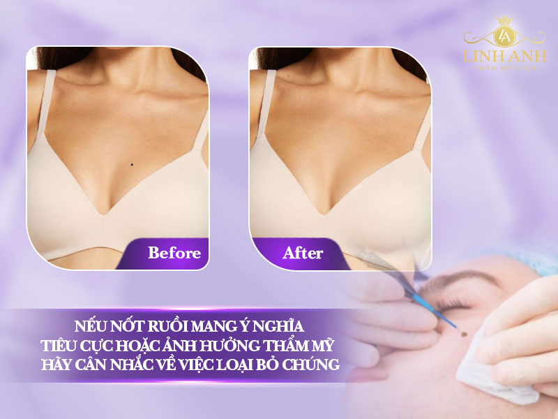 xem tướng nốt ruồi ở ngực
