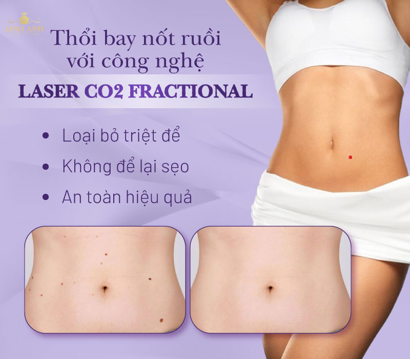 Xóa nốt ruồi ở bụng