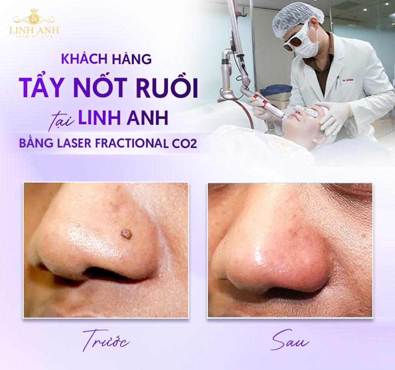 Xóa nốt ruồi ở cánh mũi