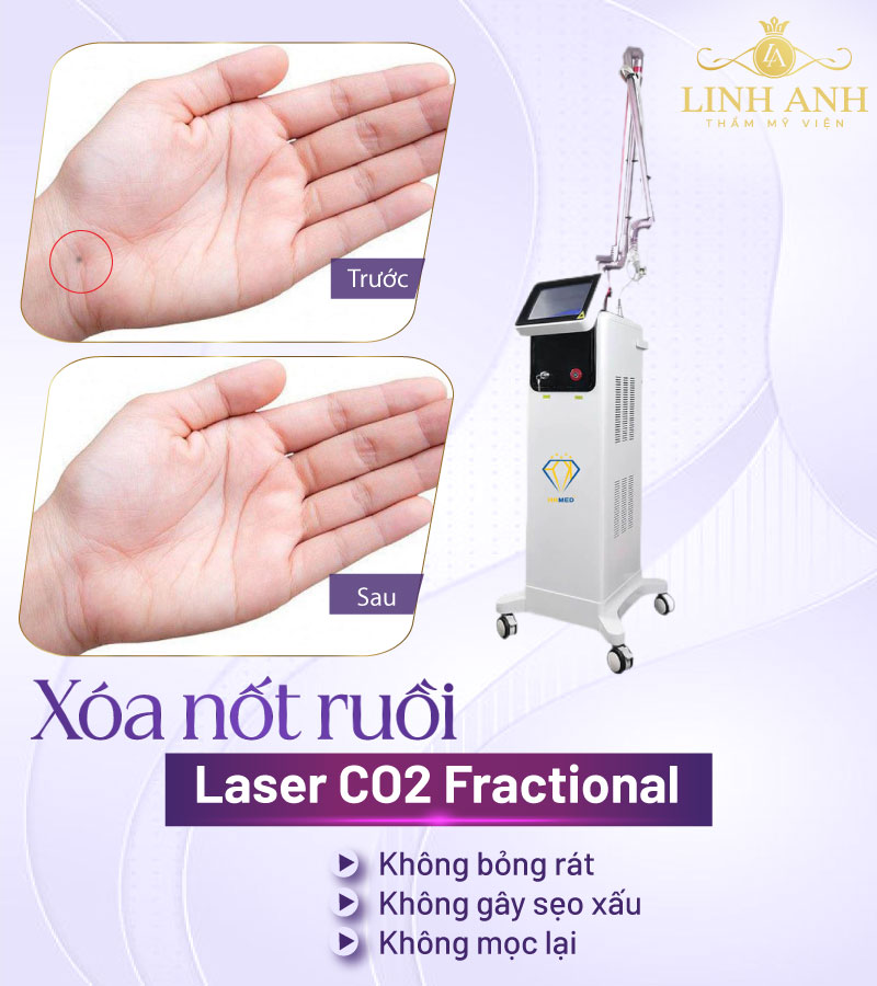 Xóa Nốt ruồi ở cổ tay