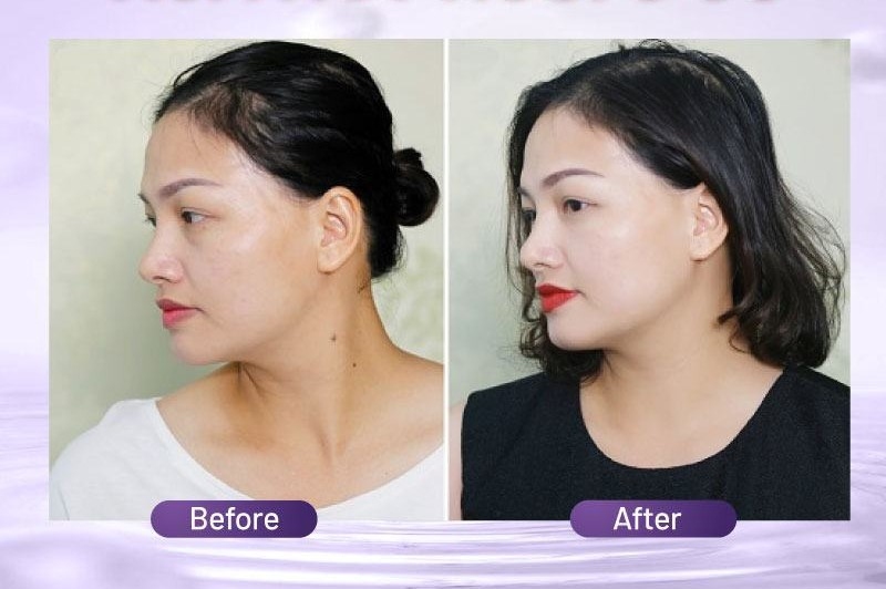 Xóa nốt ruồi ở cổ