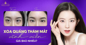 xóa quầng thâm mắt vĩnh viễn giá bao nhiêu