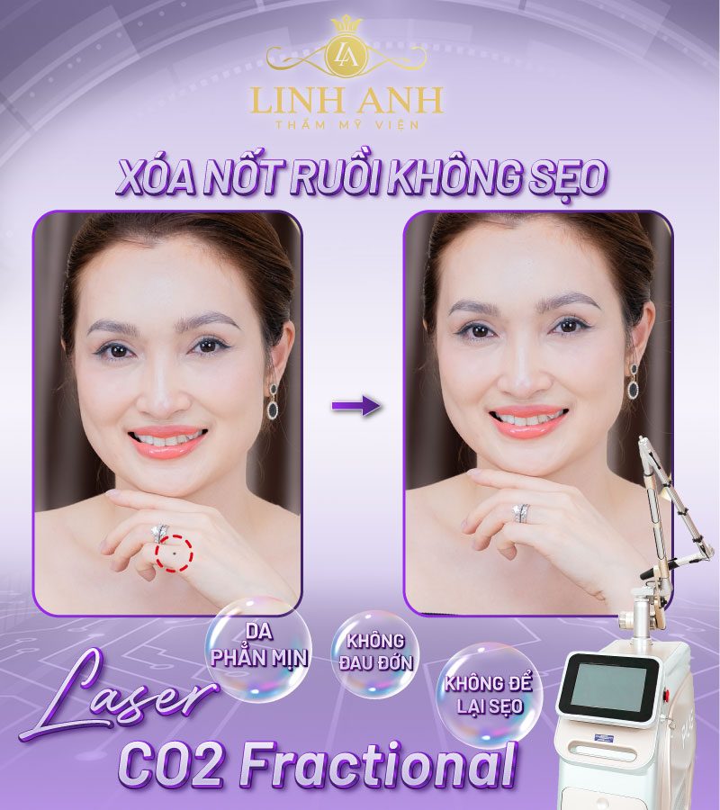 ý nghĩa nốt ruồi ở đùi