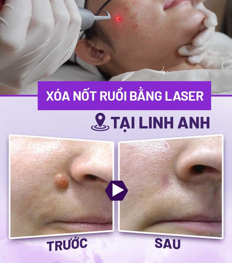 ý nghĩa nốt ruồi sau gáy