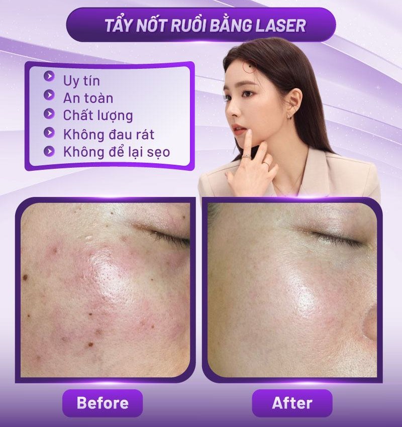 ý nghĩa nốt ruồi trên đầu ý nghĩa nốt ruồi trên đầu