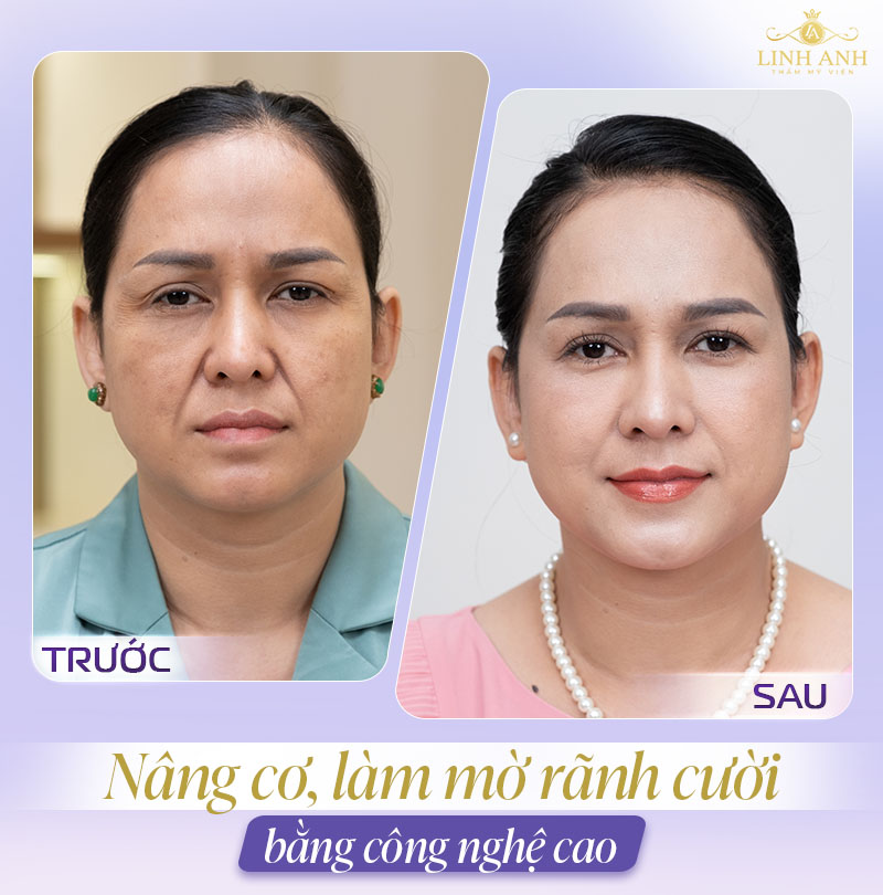 ảnh tiêm rãnh cười