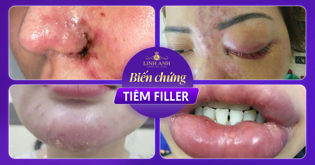 Biến chứng tiêm filler