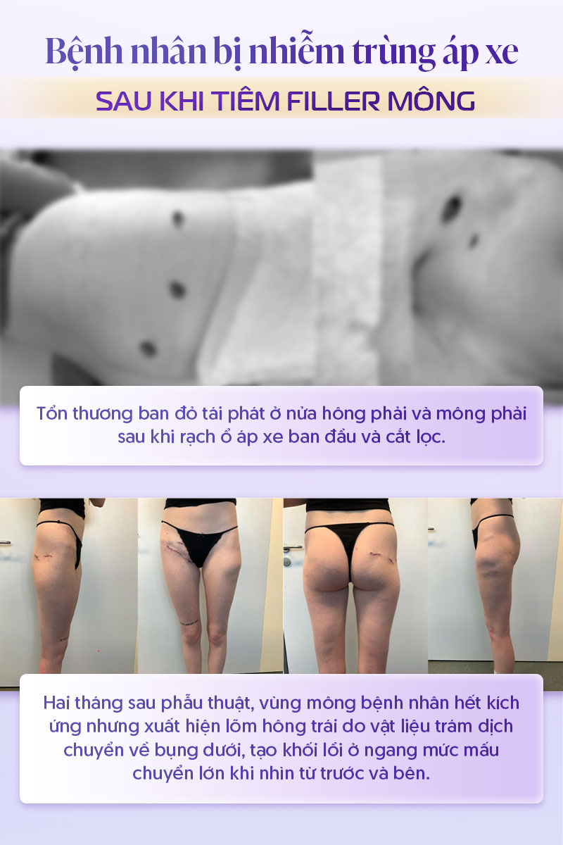 Biến chứng tiêm filler mông