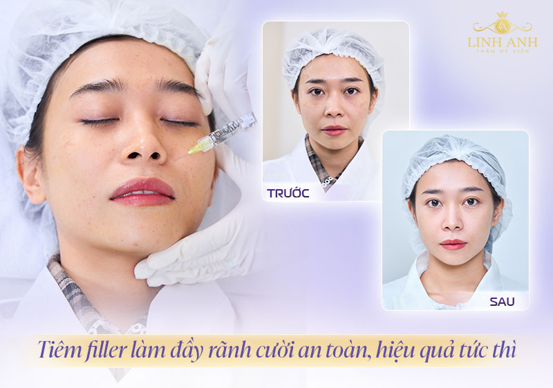 Cách làm đầy rãnh cười