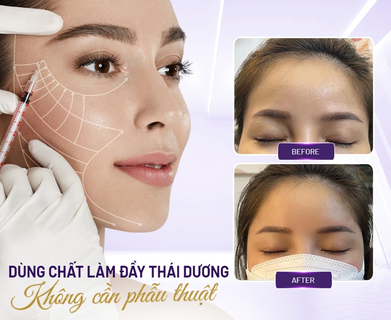 Cách làm đầy thái dương