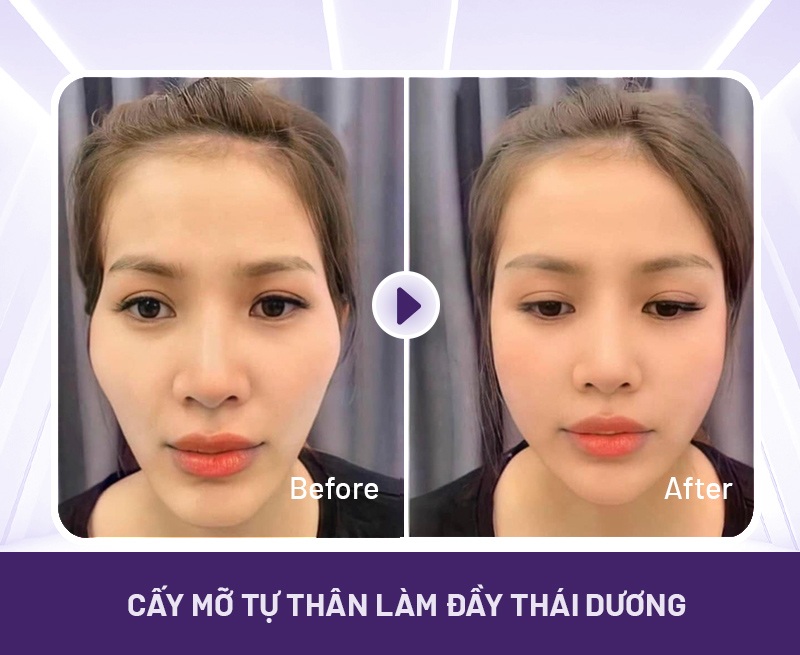 Cấy mỡ thái dương