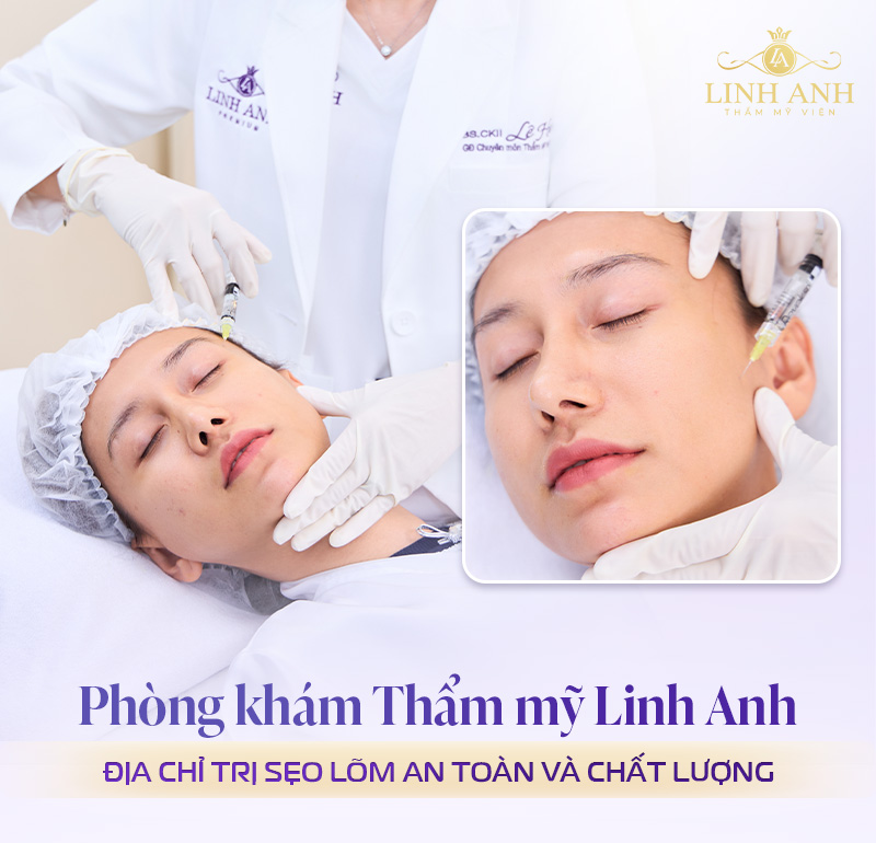 Địa chỉ Tiêm filler làm đầy sẹo lõm