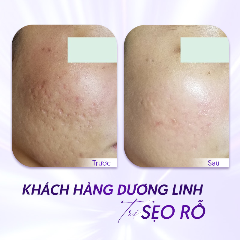 địa chỉ trị sẹo rỗ