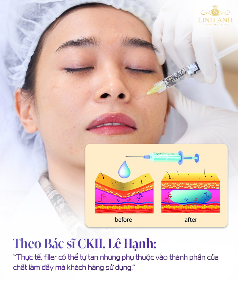 Filler bao lâu thì tan