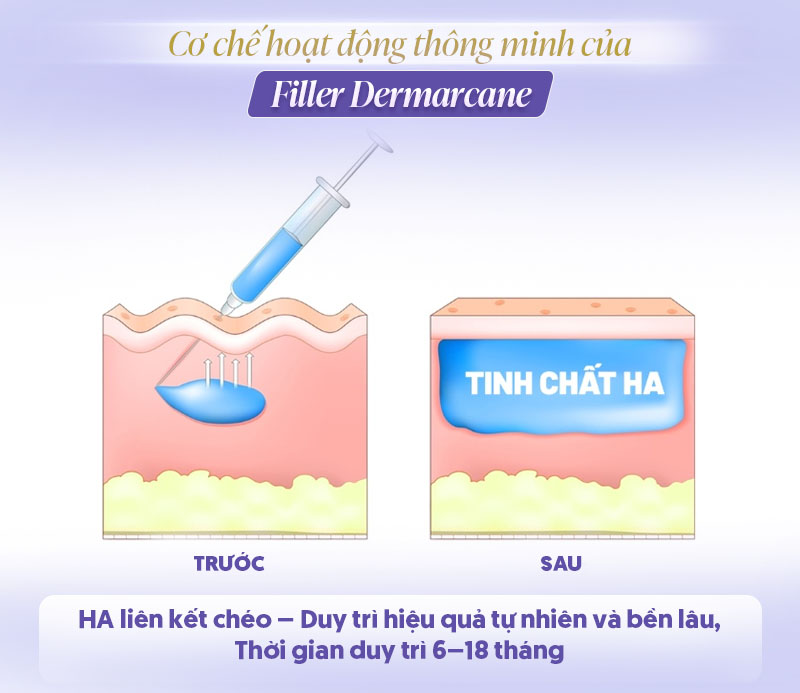 Filler Dermarcane giữ được bao lâu Filler Dermarcane giữ được bao lâu