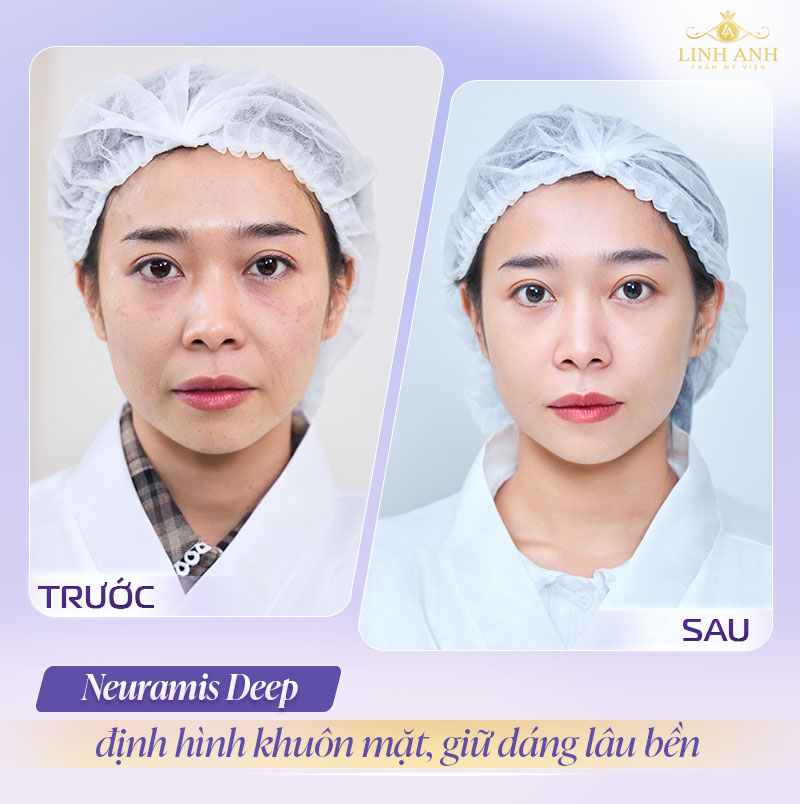 Filler neuramis giữ được bao lâu