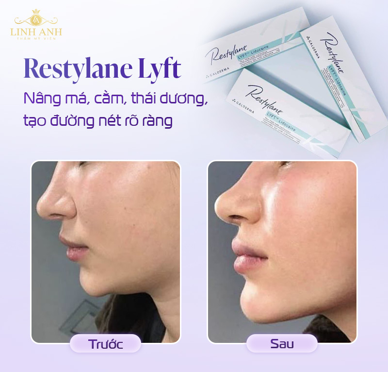 Filler Restylane có mấy loại