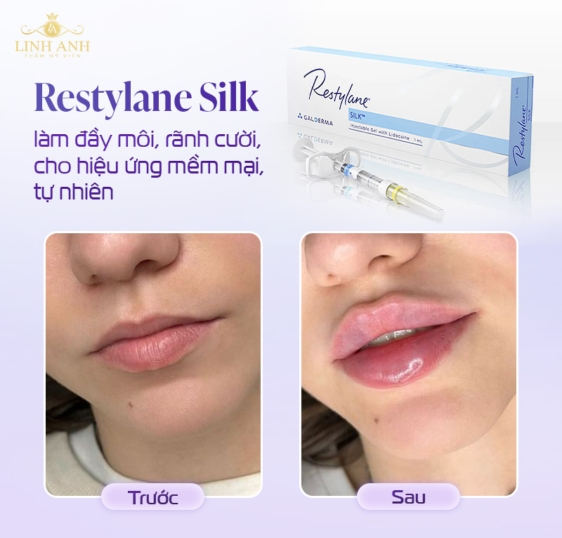 Filler Restylane rãnh cười