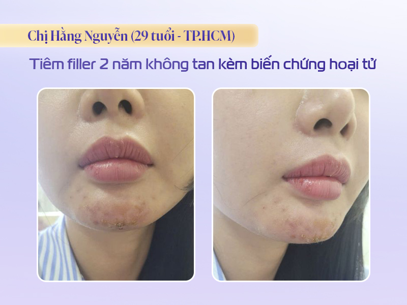 Hinh ảnh filler 2 năm không tan