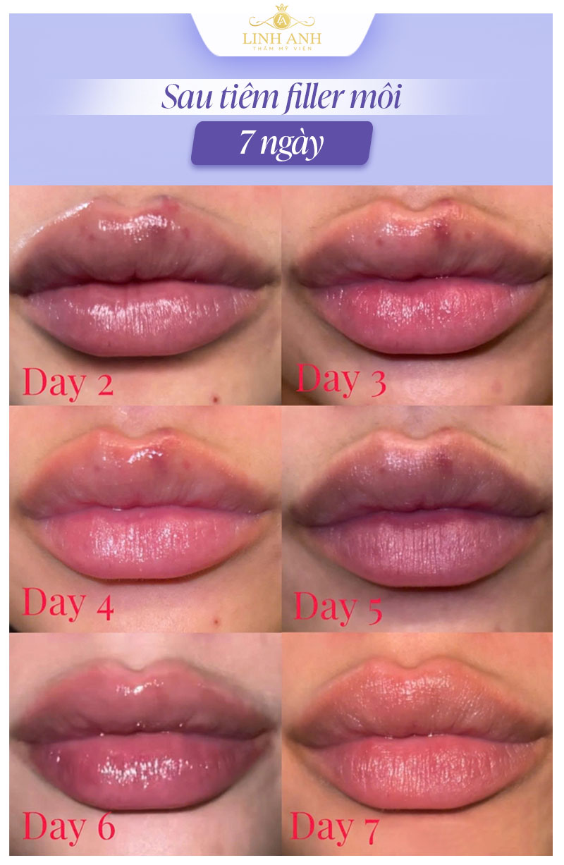 Hình ảnh môi sau tiêm filler 7 ngày