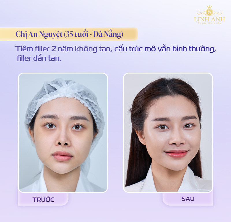 Hình ảnh sau tiêm filler thành công