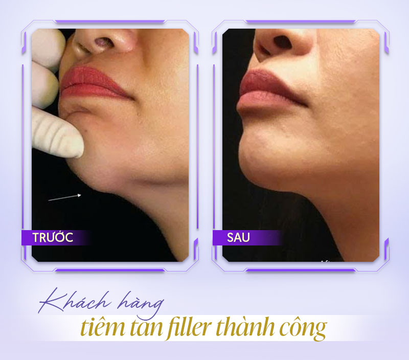 Hình ảnh sau tiêm tan filler